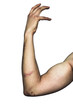 bruised arm