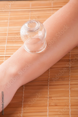 Photo: Cupping-glass on acupuncture Cupping-glass on acupuncture