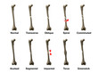 All Types of Bone Fractures