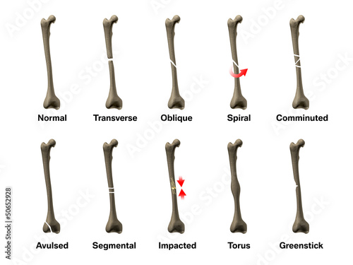 Illustration: All Types of Bone Fractures All Types of Bone Fractures