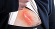 Surgery scar