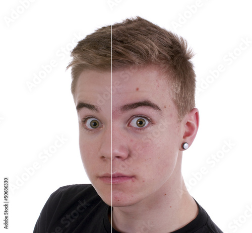 Photo: Teenager mit reiner und unreiner Haut Teenager mit reiner und unreiner Haut