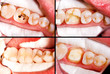 Before and after