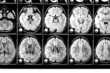 X-ray image of the brain computed tomography
