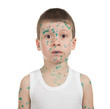 sick child. chickenpox