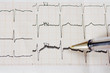 Arrhythmia