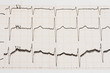 Arrhythmia