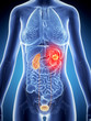 3d rendered illustration of female kidney cancer