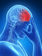 3d rendered conceptual illustration of head pain