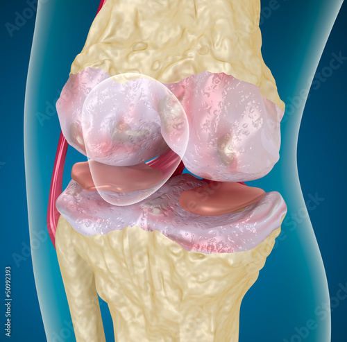 Illustration: Osteoarthritis : Knee Osteoarthritis : Knee