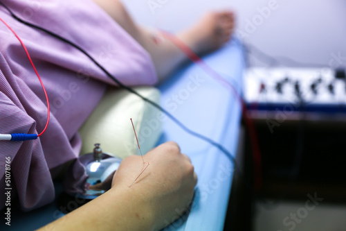 Photo: Hand of a woman with electrical stimulating acupuncture treatmen Hand of a woman with electrical stimulating acupuncture treatmen