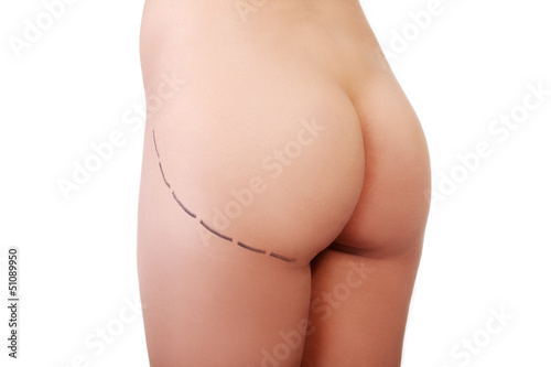 Photo: Woman's buttock prepared to plastic surgery Woman's buttock prepared to plastic surgery