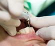 Detail of finishing dental filling on front tooth