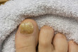 Foto: Nagelpilz Nagelpilz