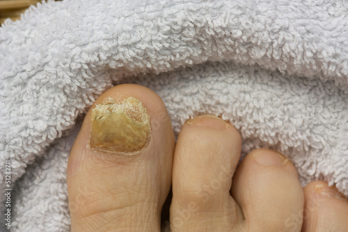 Photo: Nagelpilz Nagelpilz