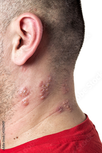 Photo: shingles virus shingles virus