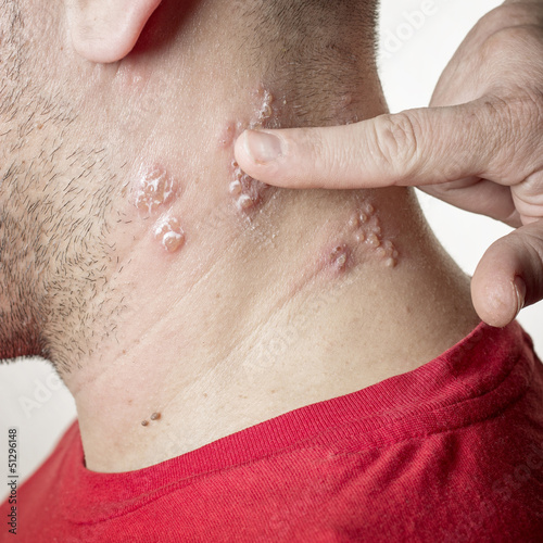 Photo: shingles virus shingles virus