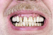 Yellow teeth  studio shot