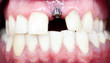 Photo: dental implant dental implant
