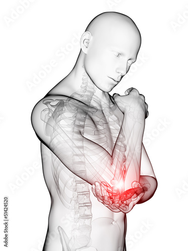 Illustration: 3d rendered medical illustration - painful elbow 3d rendered medical illustration - painful elbow