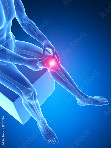 Illustration: 3d rendered medical illustration - painful knee 3d rendered medical illustration - painful knee