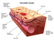 Vector: varicella zoster varicella zoster