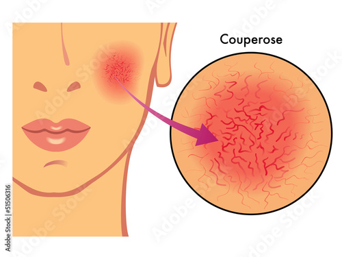 Vector: couperose couperose