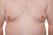Male thorax showing early stage Gynecomastia