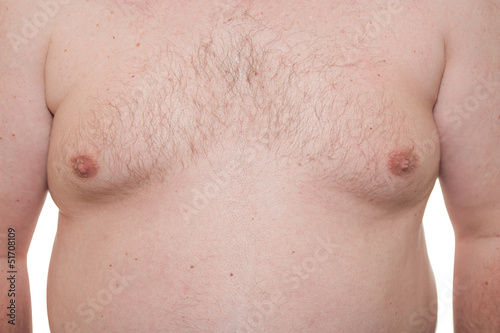 Photo: Male thorax showing early stage Gynecomastia Male thorax showing early stage Gynecomastia