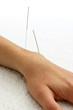 Two silver acupuncture needles in hand