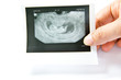 12 weeks baby ultrasound Image