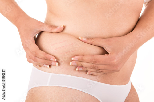 Photo: Woman showing her new stretch marks Woman showing her new stretch marks