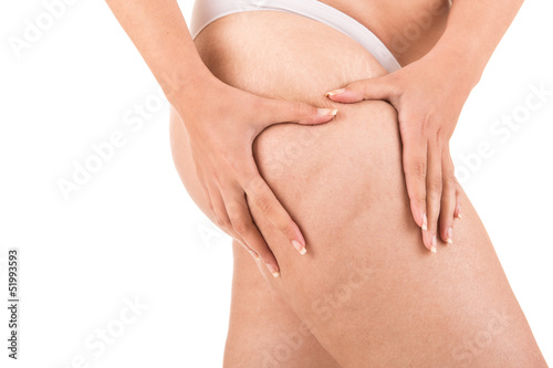 Photo: Woman showing her cellulite Woman showing her cellulite