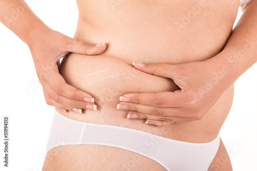 Photo: Woman showing her old stretch marks Woman showing her old stretch marks