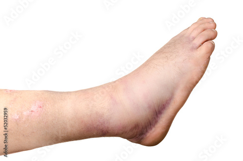 Photo: Broken ankle of a person isolated on white background Broken ankle of a person isolated on white background
