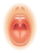afta linguale