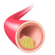 Illustration: Arteriosklerose Querschnitt - 3D illustration Arteriosklerose Querschnitt - 3D illustration