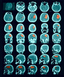 Photo: CT scan of the brain. Hemorrhagic stroke. CT scan of the brain. Hemorrhagic stroke.