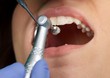 Professional dental brushing