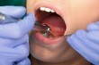 Dental drilling