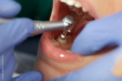 Photo: Professional dental brushing Professional dental brushing