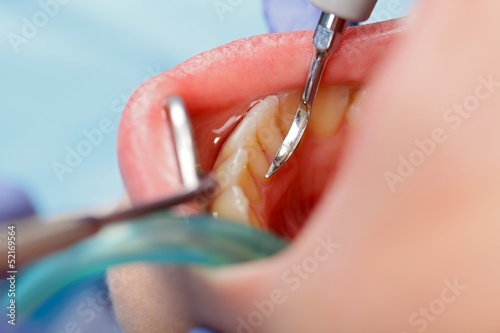 Photo: Dental calculus removing Dental calculus removing