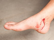 Incised wound on the leg of a man