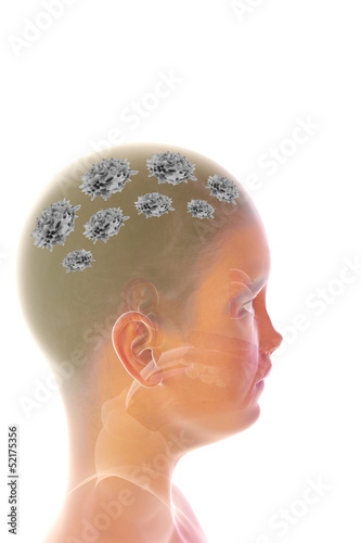 Illustration: Psoriasis (Schuppenflechte) - 3D Render Psoriasis (Schuppenflechte) - 3D Render