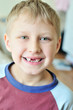 smile without teeth