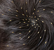 Illustration: Head Lice Head Lice