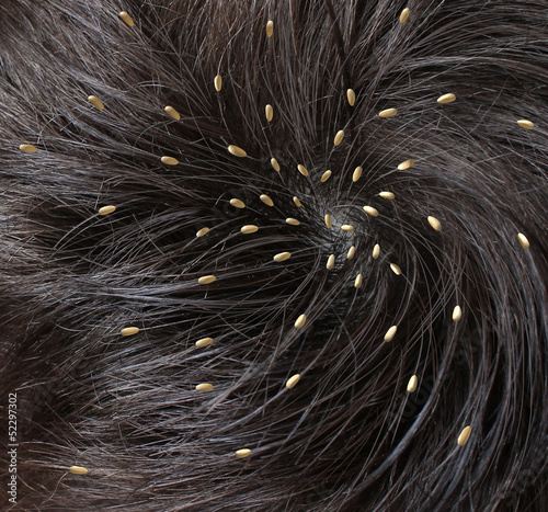 Illustration: Head Lice Head Lice