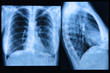 Chest X-ray Image