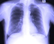 X-Ray Image Of Human Chest