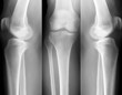 human leg bone X-rays